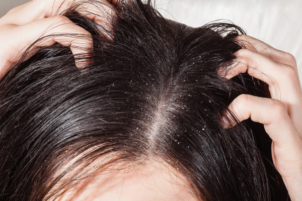 Как оздоровить кожу головы: 7 важных правил от экспертов  